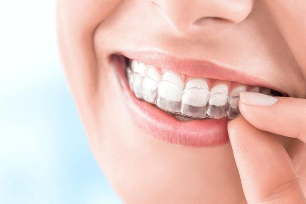 Что лучше – элайнеры или брекеты?